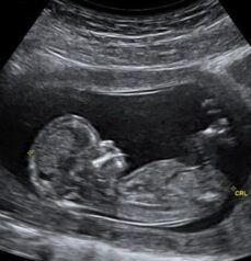 A monochrome image illustrating a baby nestled in the uterus, highlighting the early stages of human development.